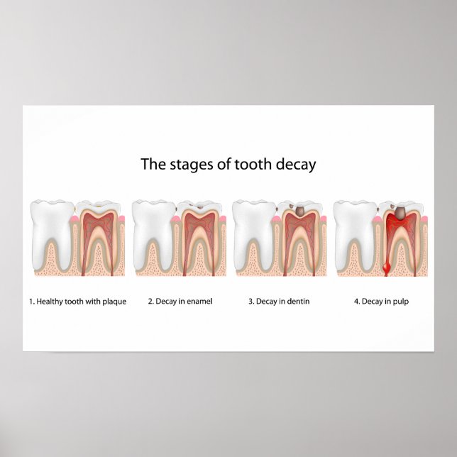 Tooth decay Poster (Front)