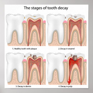 Tooth decay Poster