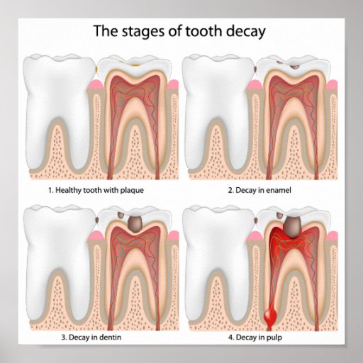 Tooth decay Poster | Zazzle