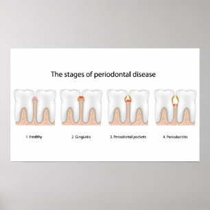 Tooth Periodontal Disease Poster