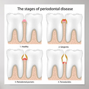 Tooth Periodontal Disease Poster