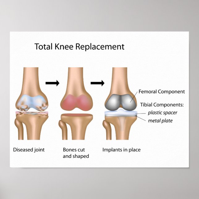 Total knee replacement surgery poster (Front)