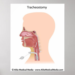 Tracheostomy drawing. poster
