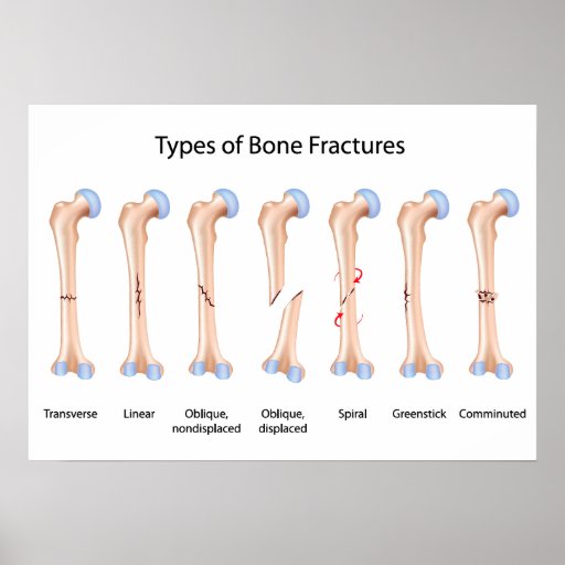 Types of bone fractures Poster | Zazzle