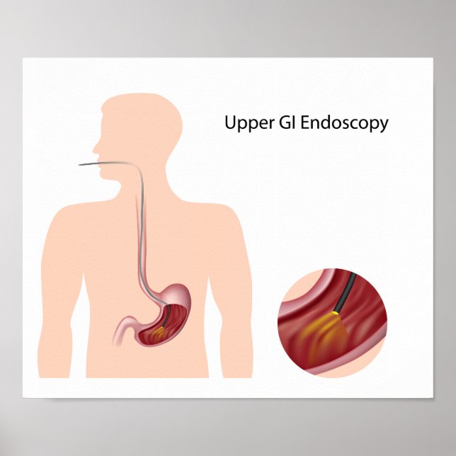 Upper GI endoscopy Poster (Front)