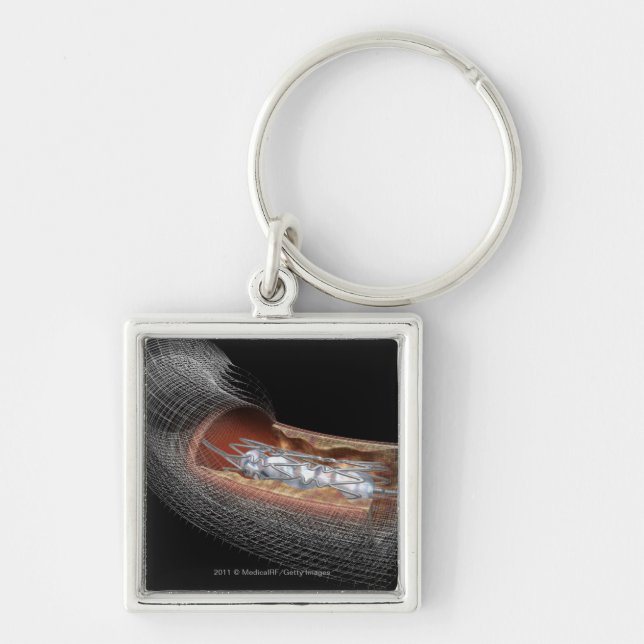 View of an angioplaty balloon in an artery key ring (Front)
