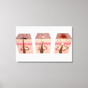 View of what causes acne canvas print