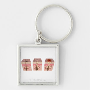 View of what causes acne key ring