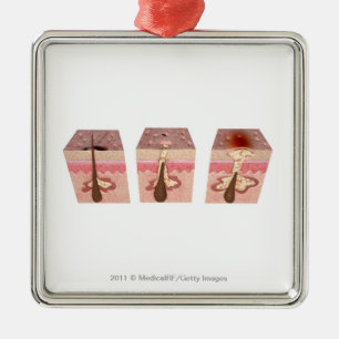 View of what causes acne metal tree decoration