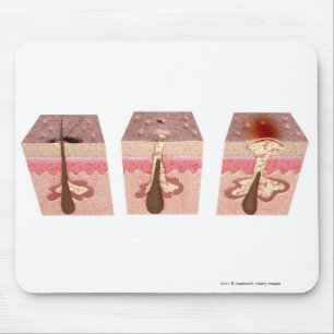 View of what causes acne mouse mat