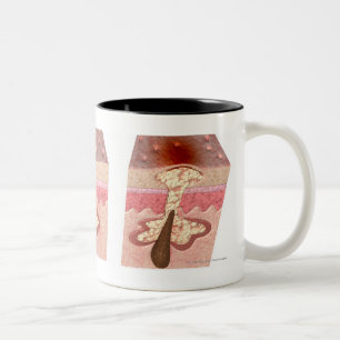 View of what causes acne Two-Tone coffee mug