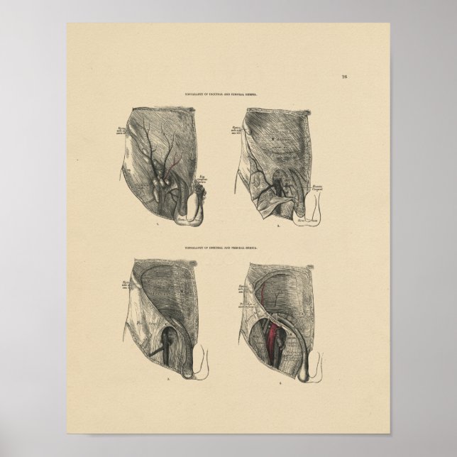Vintage Hernia Anatomy 1880 Print (Front)