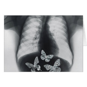 X-ray of butterflies in the stomach
