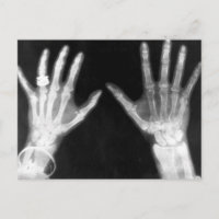 X-Ray Skeleton Hands & Jewelry - B&W