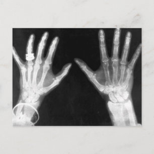 X-Ray Skeleton Hands & Jewelry - B&W Postcard