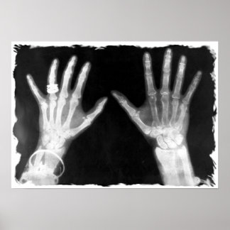 X-Ray Skeleton Hands & Jewelry - B&W Poster
