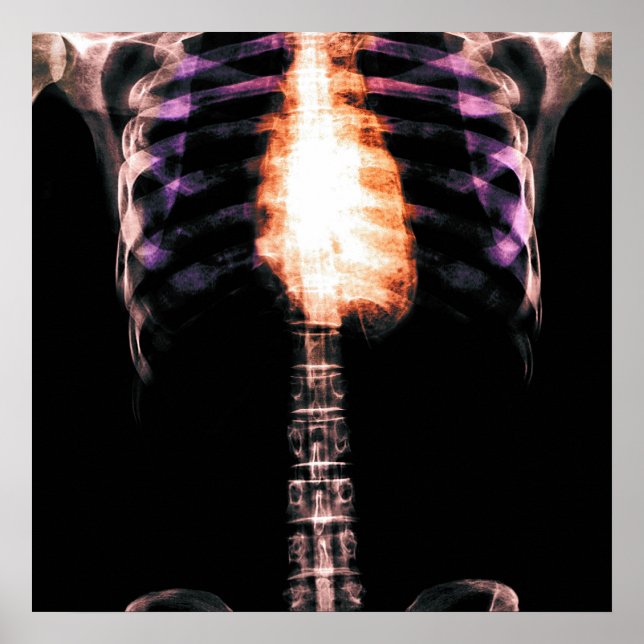 X-RAY SKELETON TORSO RIBS - ORIGINAL POSTER (Front)