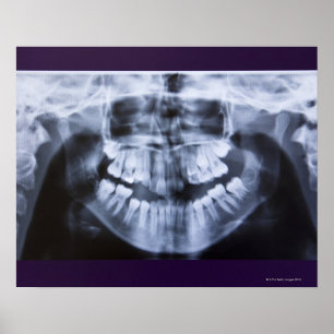 Xray of a girls jawline taken with a panoramic poster